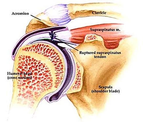 Tendinite do tendão supra-espinhal do ombro: comum em quem pratica esportes a remo (foto: Reprodução)